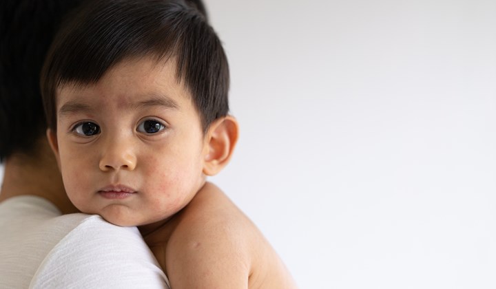 Infant suffering from atopic eczema Infant suffering from atopic eczema