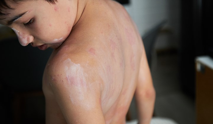 Eczema can lead to a red, loosely circumscribed rash, particularly in children. Child suffering from Eczema